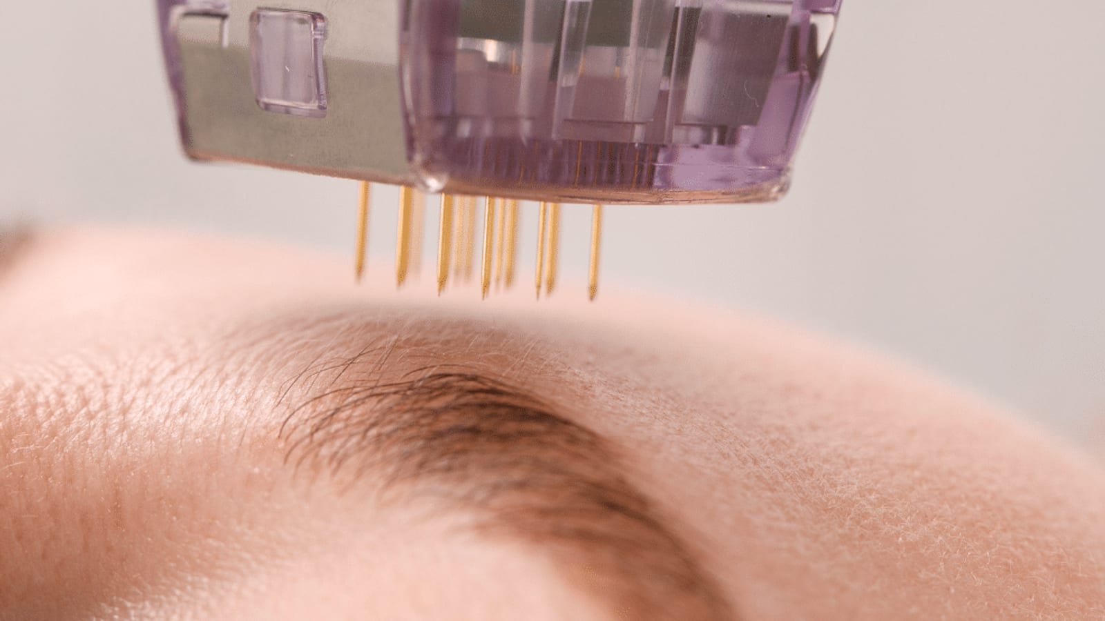 We Looked at the Clinical Studies: Does Micro Needling Really Work for Acne Scars?