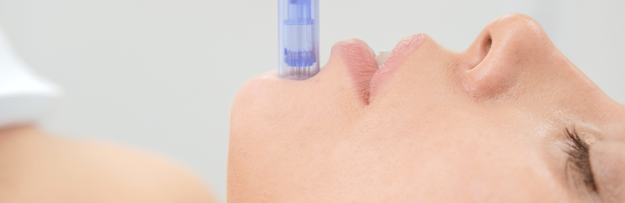Microneedling with Exosomes: Benefits, Results, and Cost