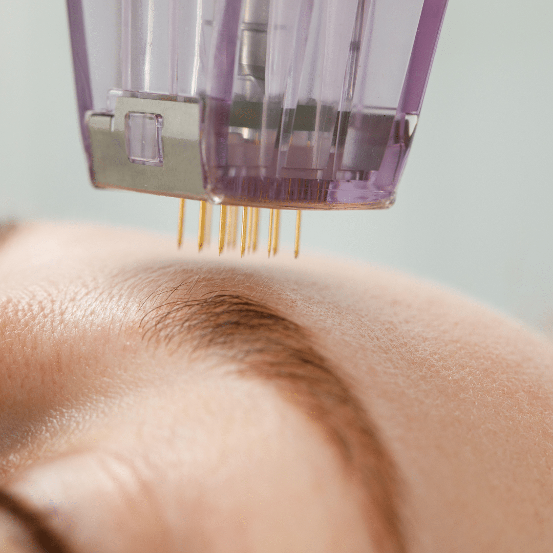 Does Microneedling Work for Acne Scars? What the Studies Say